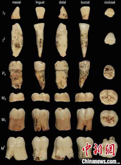 一颗先驱人的牙齿经过了古蛋白分析(版权 Prof. José María Bermúdez de Castro)。　《自然》供图 摄